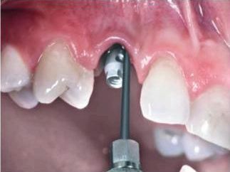 Лечение периимплантита полость рта