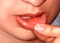 Хронический рецидивирующии афтозный стоматит полость рта