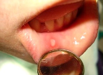 Хронический рецидивирующий афтозный стоматит слизистая оболочка полости рта