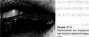Везикулярный стоматит с кожными проявлениями (вирусная пузырчатка полости рта и конечностей)