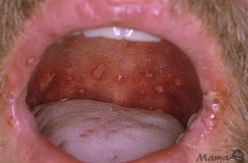 Везикулярный стоматит с кожными проявлениями (вирусная пузырчатка полости рта и конечностей) инфекция