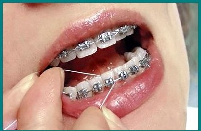 Гигиена полости рта при ортодонтическом лечении