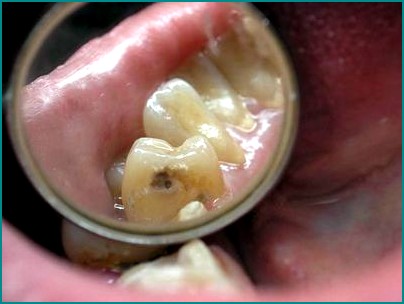 Гигиена полости рта-профилактика инфекционных заболеваний